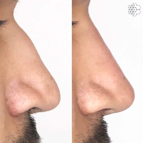 Non Surgical Nose Job