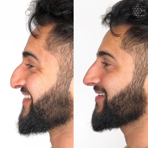 Non Surgical Nose Job