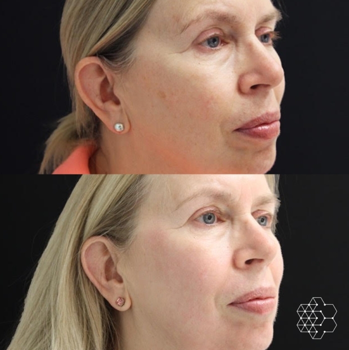 HALO™ Fractional Resurfacing