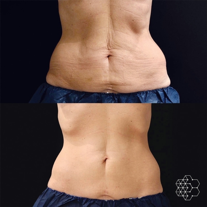 CoolSculpting with TransFORM Body Cream