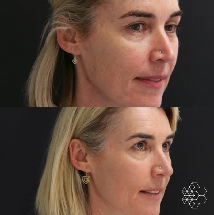 Halo Fractional Resurfacing