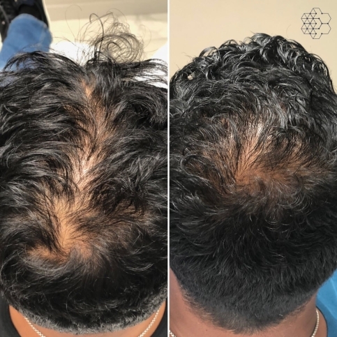 PRP Hair Restoration