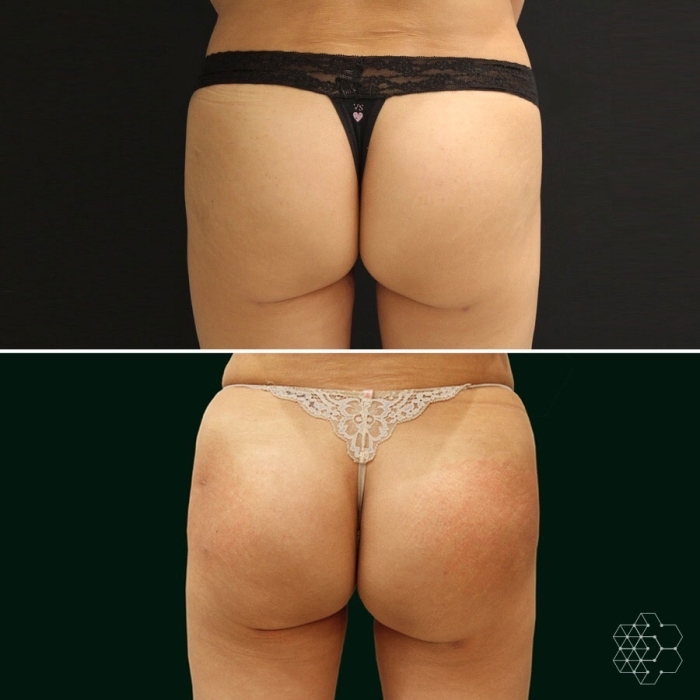Buttocks Enhancement