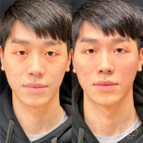 TiredEye™ Treatment