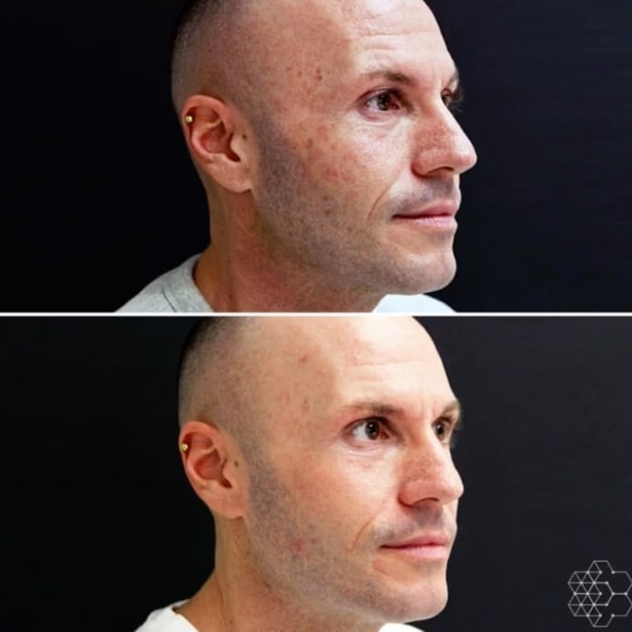 HALO™ Fractional Resurfacing