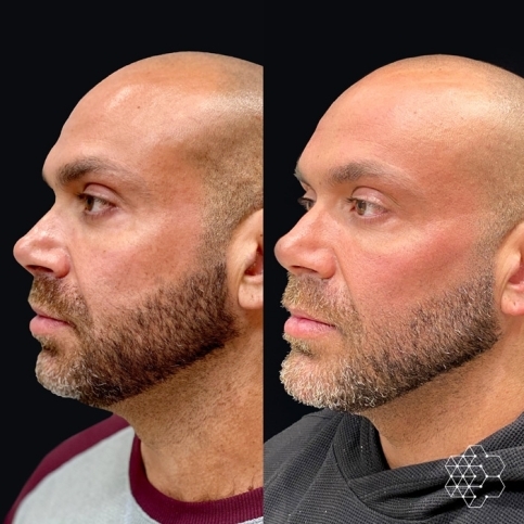 Jawline masculinization