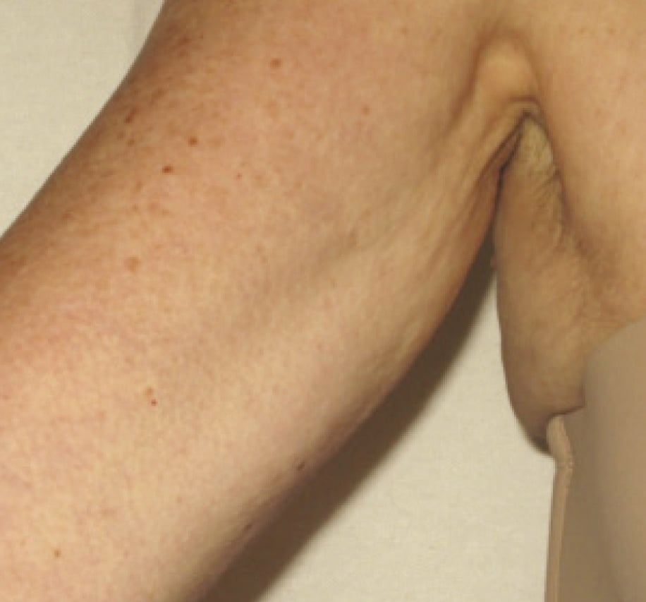 Skin Tightening & Body Contouring