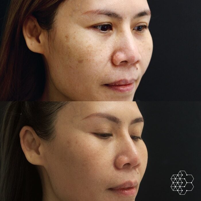 Combination of Microneedling, Halo Fractional Resurfacing and Forever Young BBL