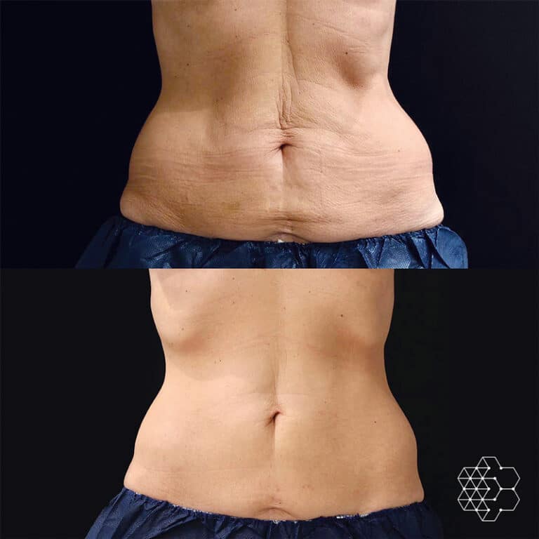 CoolSculpting