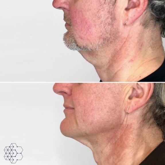 Double Chin Treatments in Vancouver, BC | Skin Technique