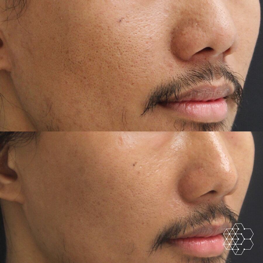  Enlarged Pore Treatments Vancouver