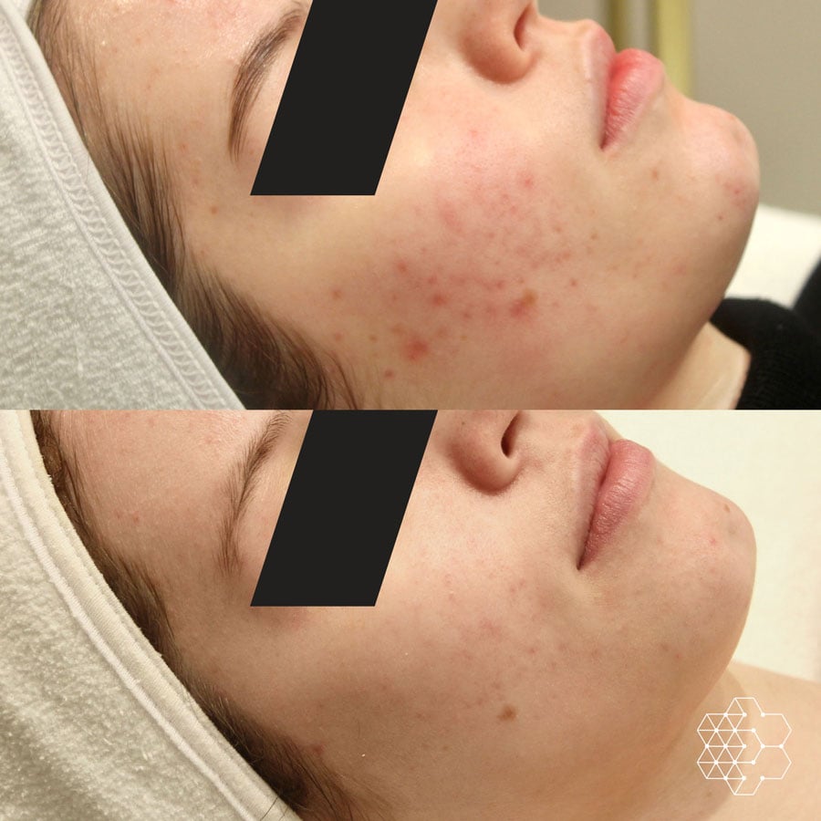 Acne Treatment in Vancouver