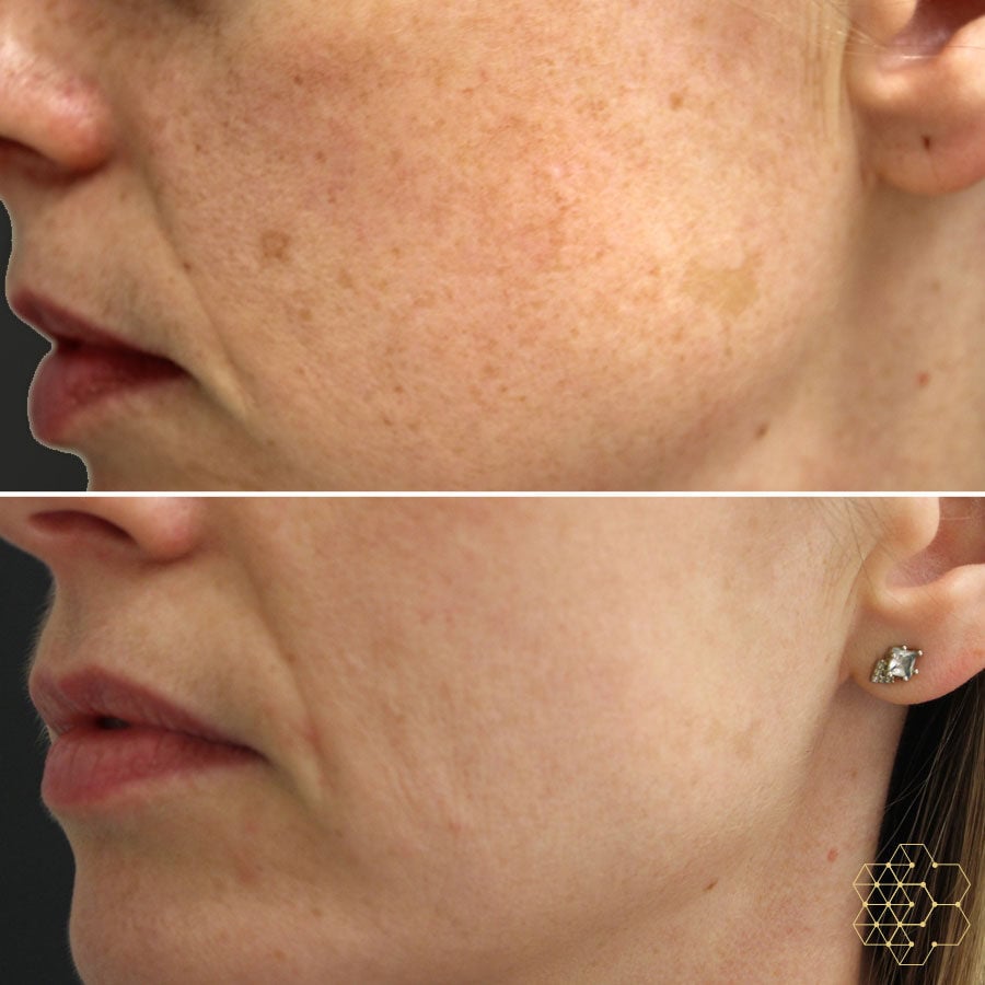 Skin Technique for IPL Treatments