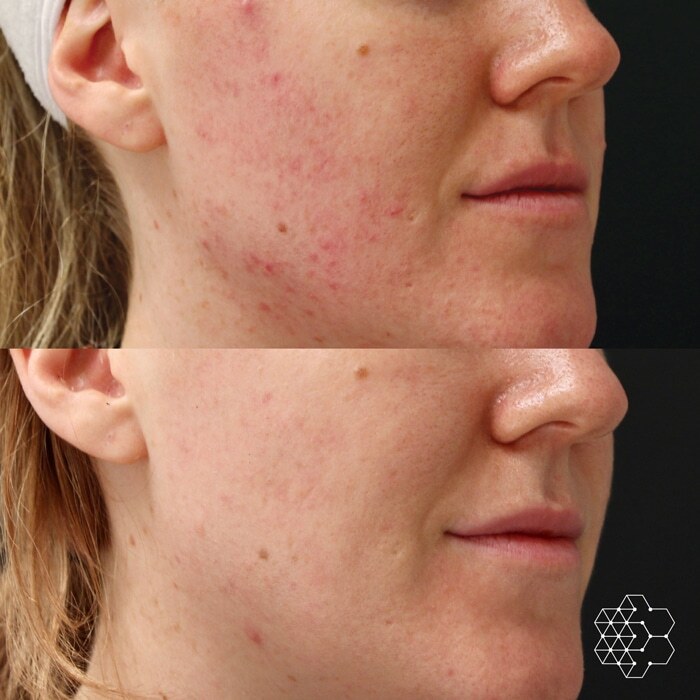 Combination of Forever Clear BBL and Forever Young BBL