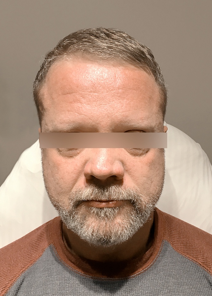 Forehead Lines Correction