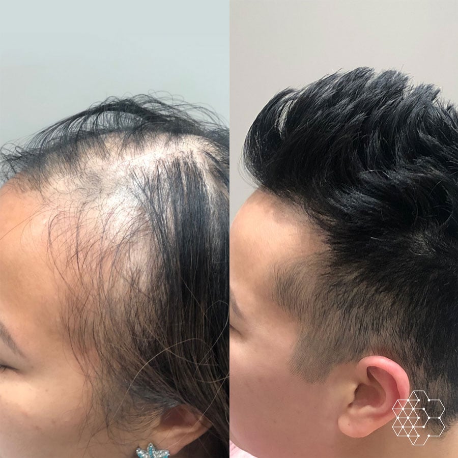 Hair Loss Treatment Clinic in Vancouver