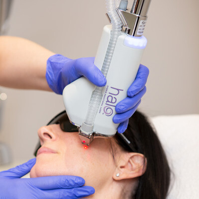 How HALO® Laser Can Benefit Your Skin: Skin Technique’s Guide&nbsp;