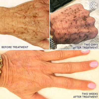 Hand Rejuvenation