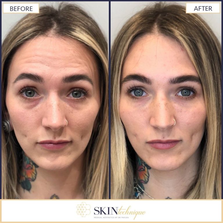 Forehead Lines Correction