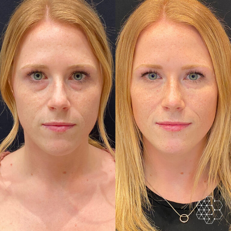 TiredEye™ Treatment