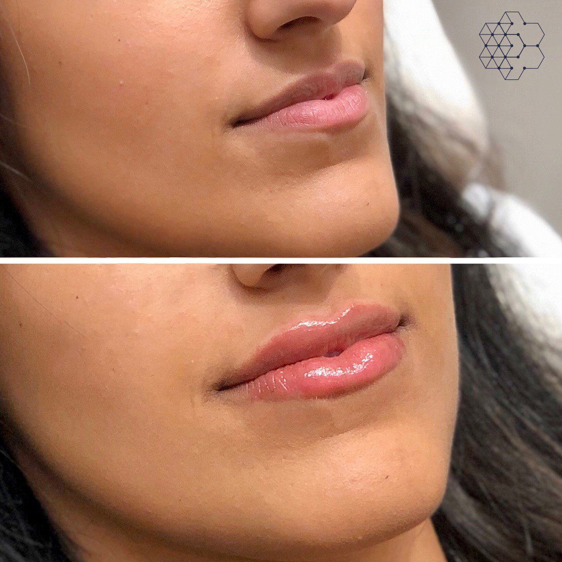 Lip Enhancement