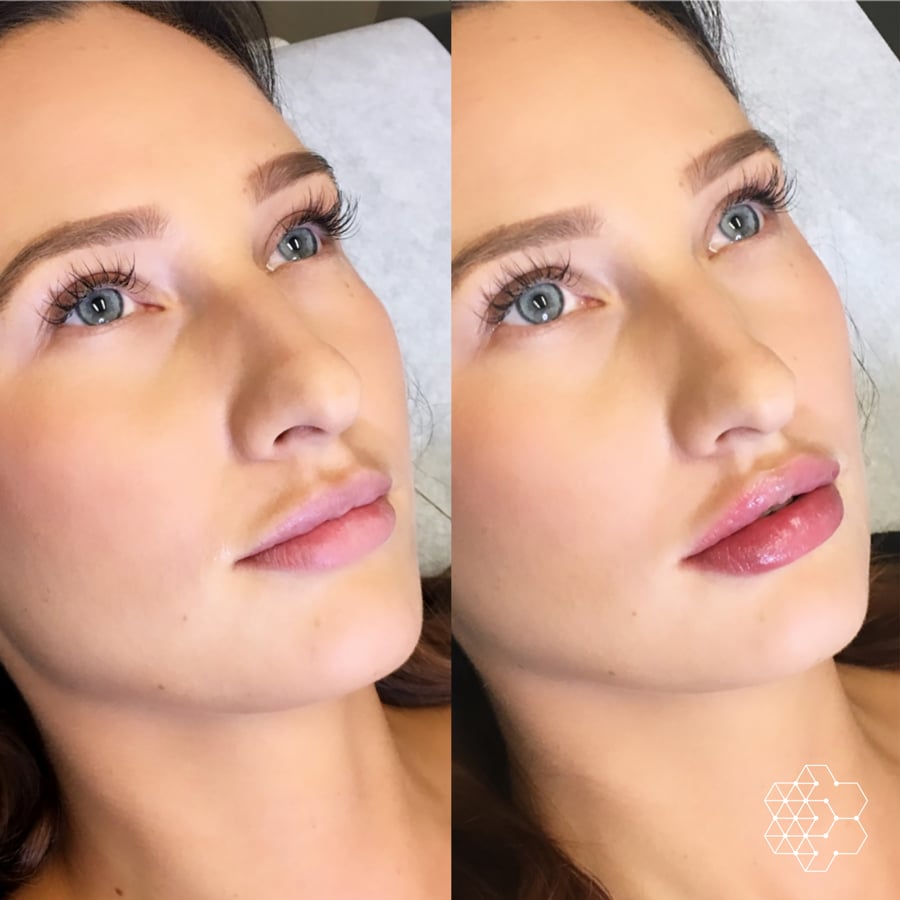 Lip Enhancement