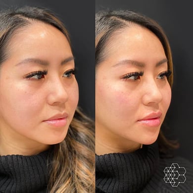 lip filler before and after vancouver