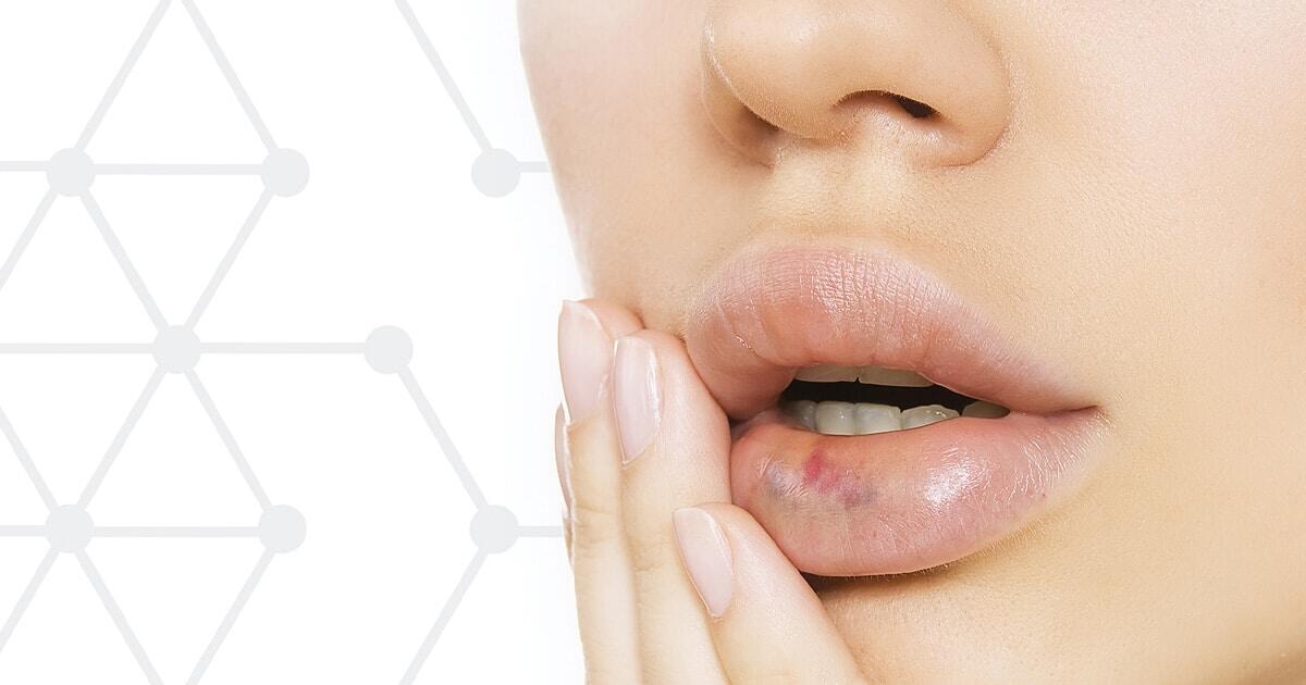 How to Avoid Bruising After Injectables