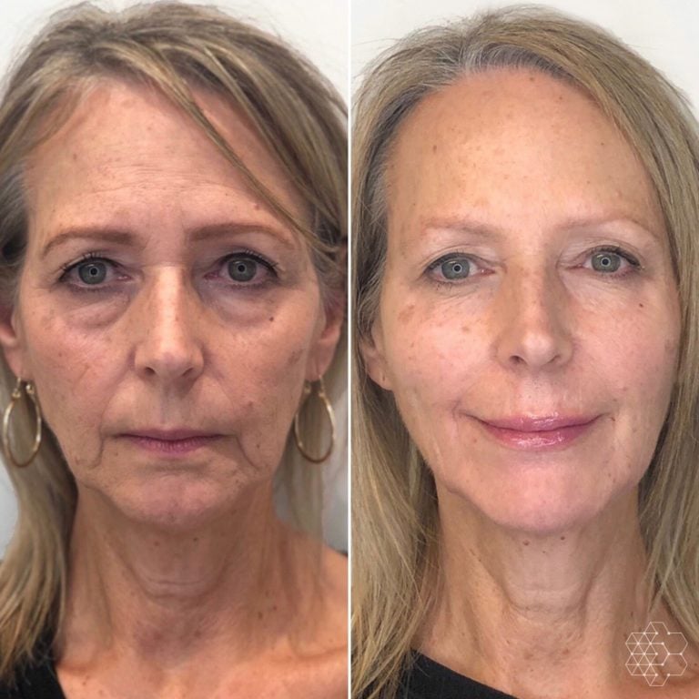 Liquid Face Lift