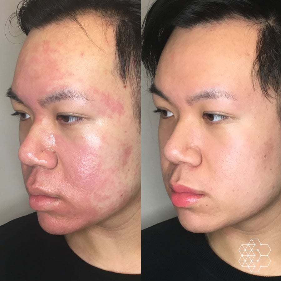 Acne Scar Treatment & Removal in Vancouver