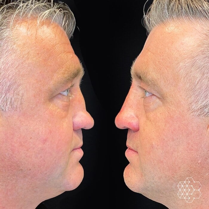 Non Surgical Nose Job