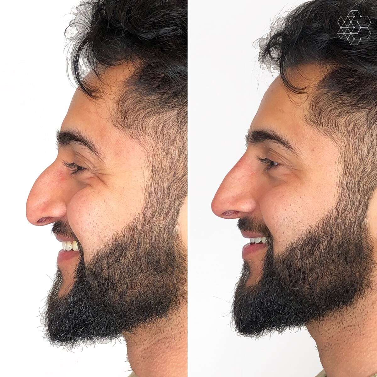 Non Surgical Nose Job