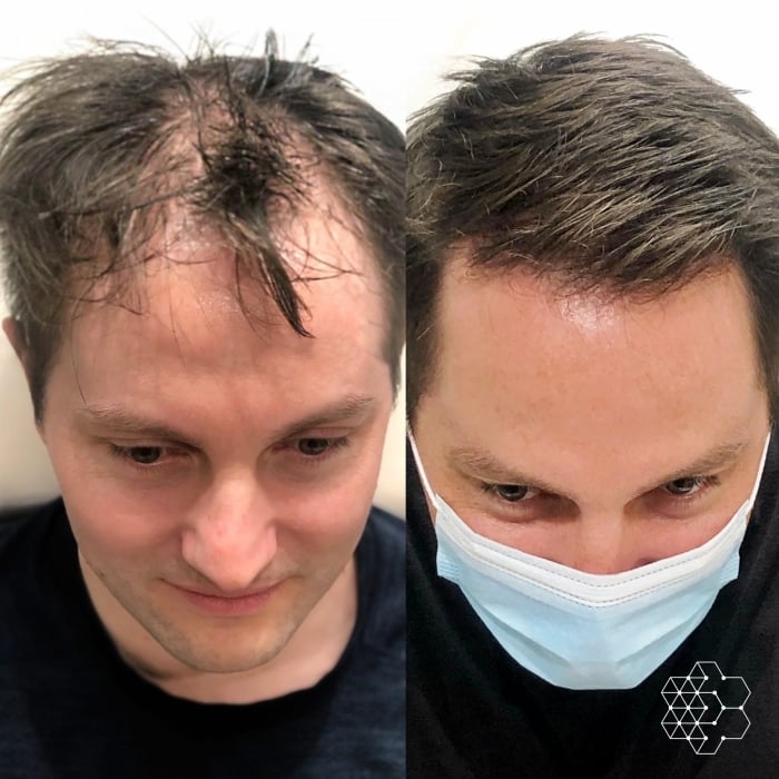PRP Hair Restoration