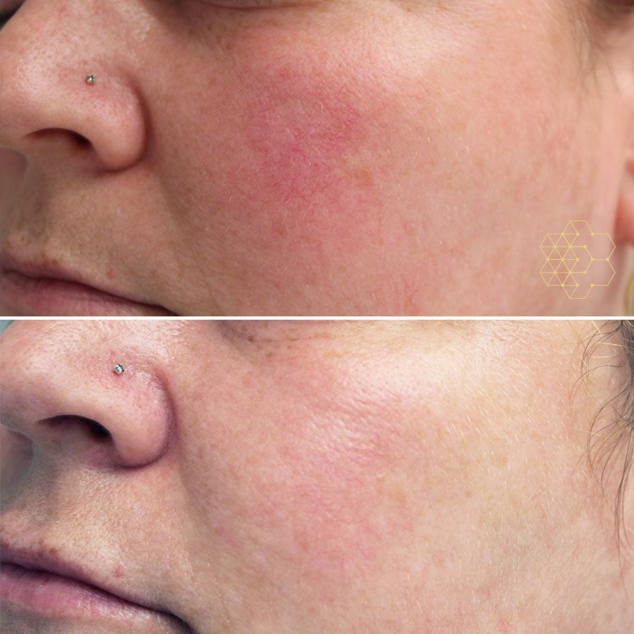 Rosacea Treatment in Vancouver