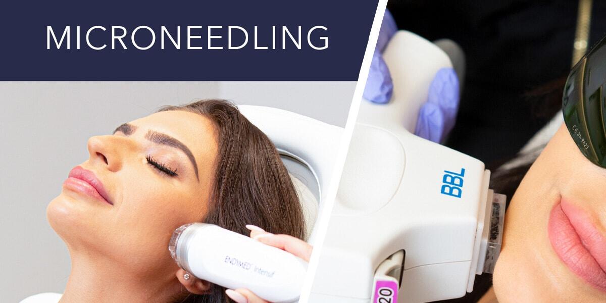 Microneedling vs Lasers Treatments