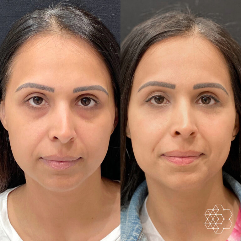 TiredEye™ Treatment