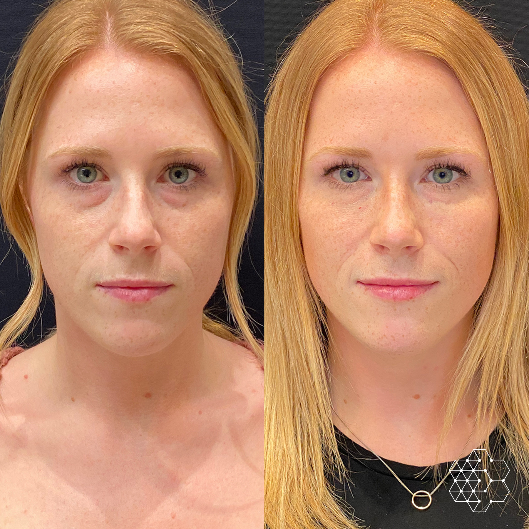 TiredEye™ Treatment