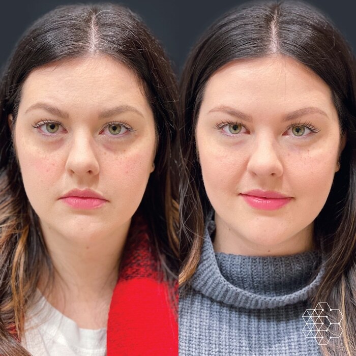 TiredEye™ Treatment