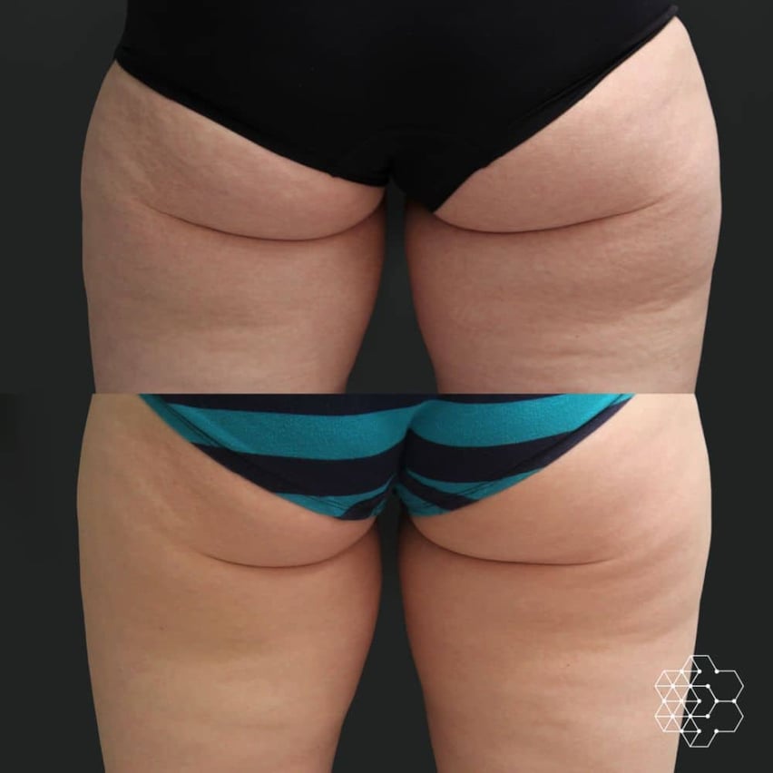 What Are the Most Common CoolSculpting Treatment Areas 2