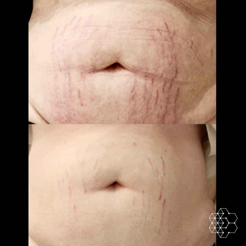 Let’s Talk about Laser Stretch Mark Removal Treatment