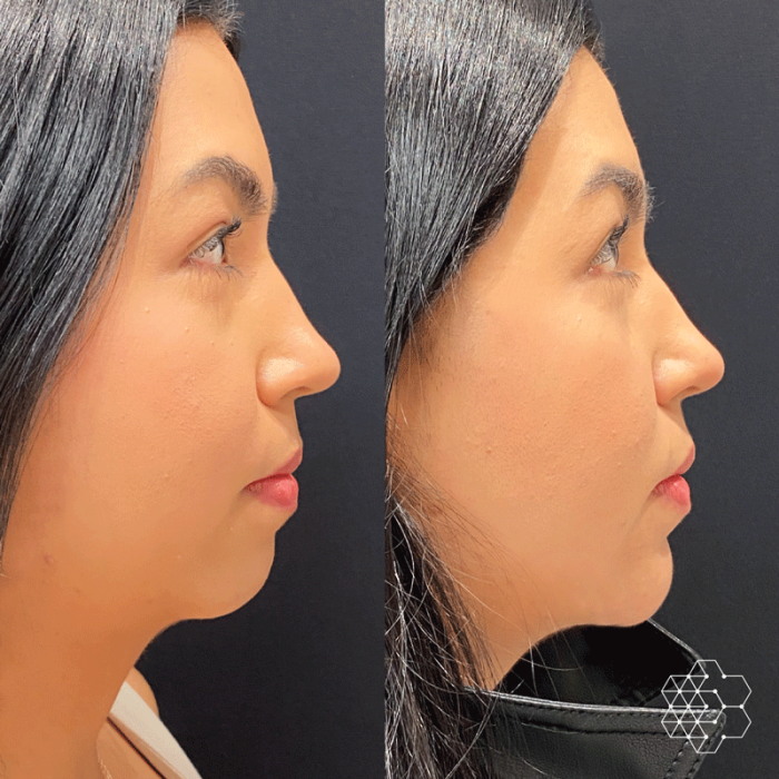 Chin Enhancement