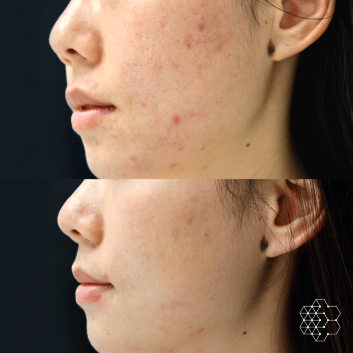 Halo and Forever Young BBL Laser Combination