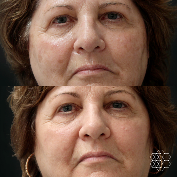 HALO™ Fractional Resurfacing