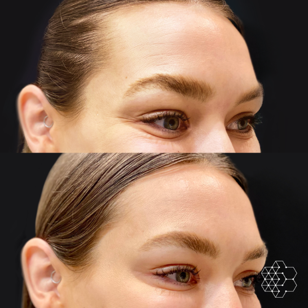 Crows Feet & Forehead Lines