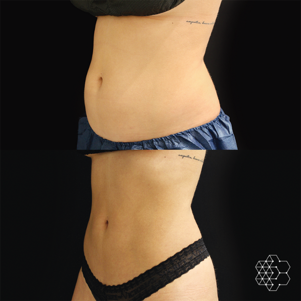 Ultimate Body Contouring Package