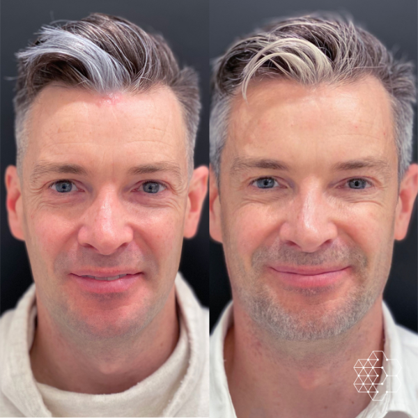 Crows Feet & Forehead Lines