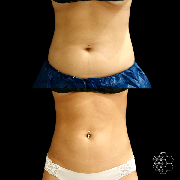 Ultimate Body Contouring Package