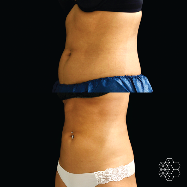 Ultimate Body Contouring Package