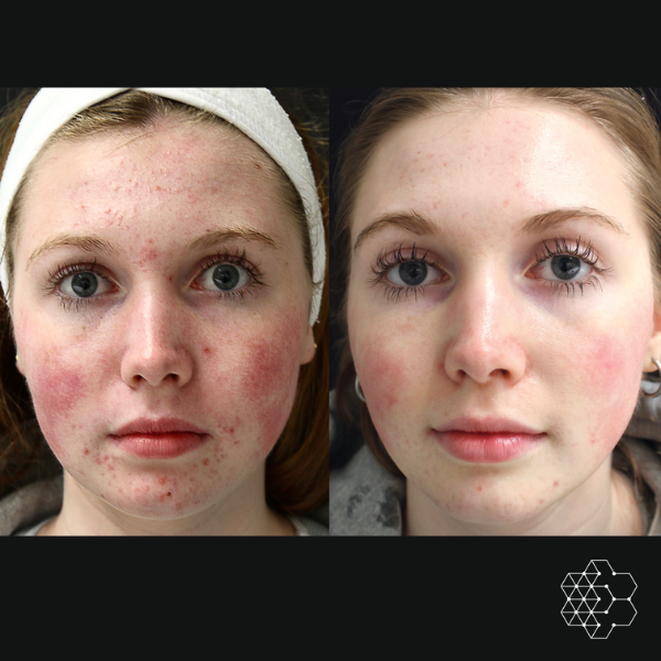 Forever Clear BBL™