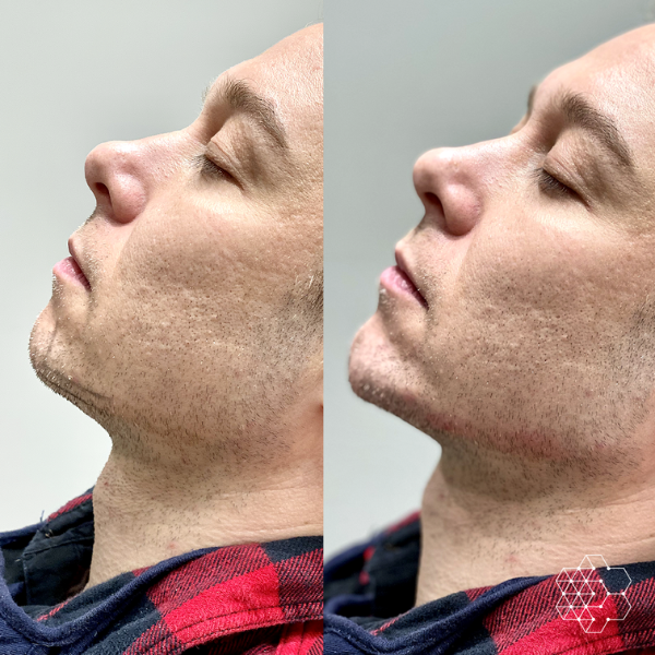 Jawline Masculinization